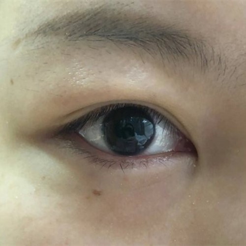 腫泡眼